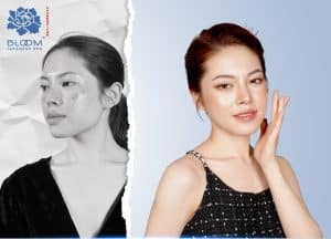 giải pháp trị nám da đến từ Nhật Bản Shimi AI tại Bloom Spa & Clinic